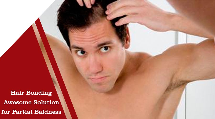 Hair Bonding Awesome Solution for Partial Baldness
