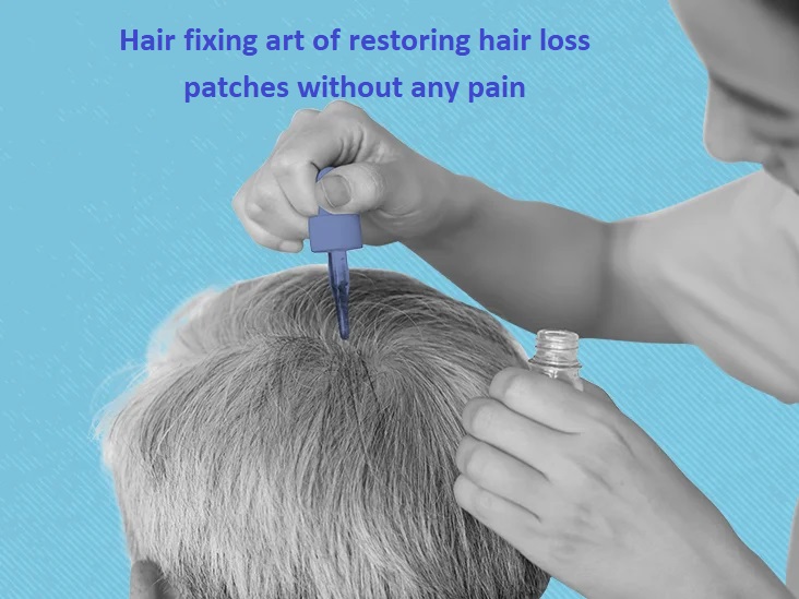 Hair fixing art of restoring hair loss patches without any pain