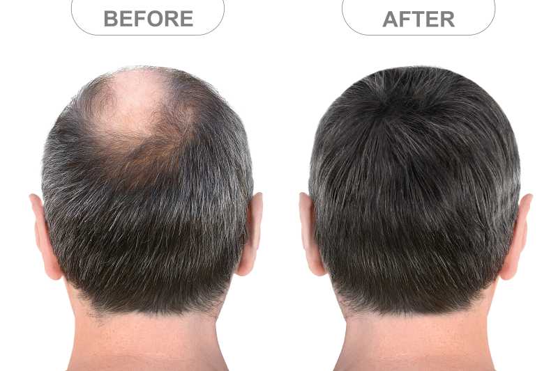 Retreat your hair loss problem with non-surgical hair fixing