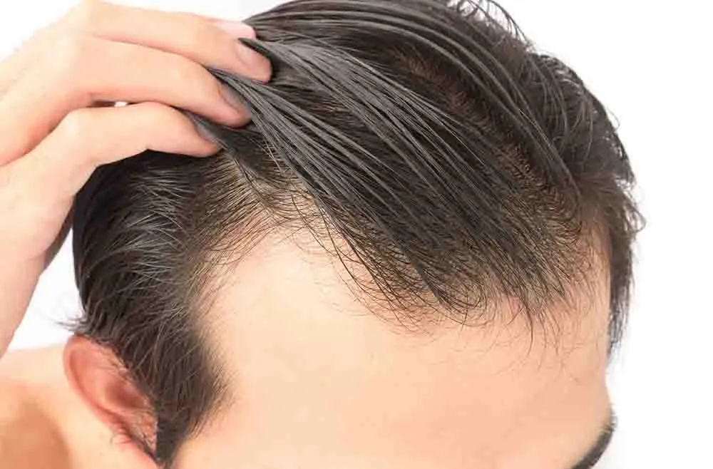 Hair Fixing Is Best Solution for Staggering Hair Loss